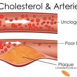 Lower Your High Cholesterol with this Simple Acton Plan